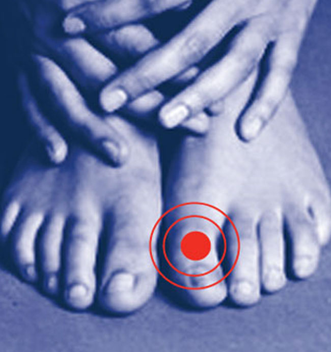Scholl – Corn, Callus & Bunions